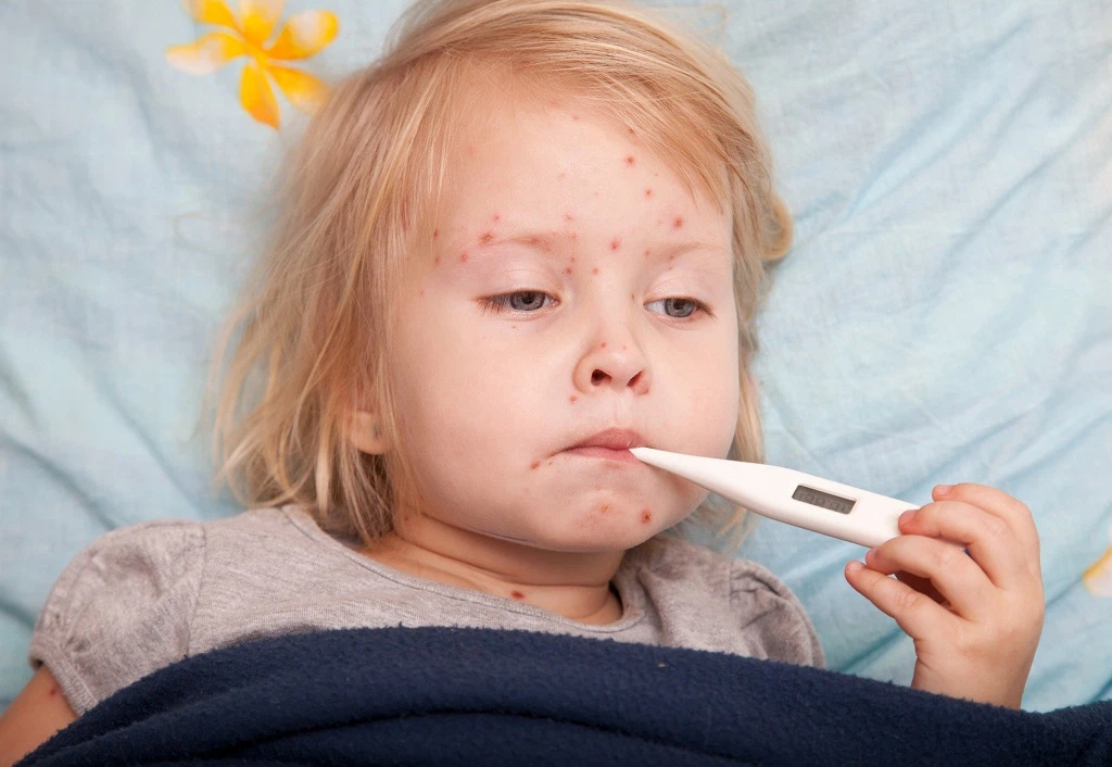 Trẻ bị thủy đậu có thể uống thuốc hạ sốt theo liều lượng phù hợp